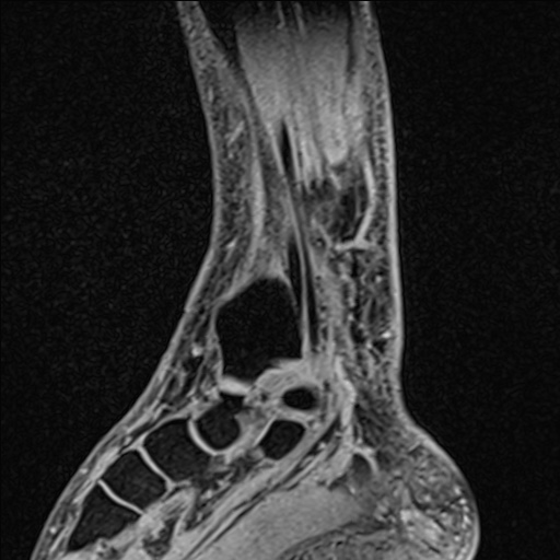 File:Bilateral Achilles tendon complete tear (Radiopaedia 81344-95051 Sagittal WE - Right 77).jpg