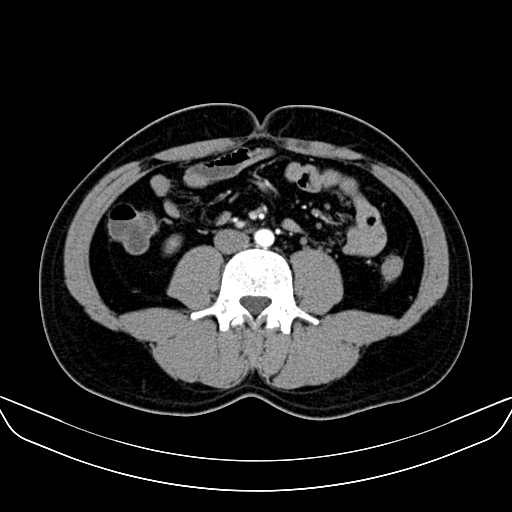 Bilateral accessory renal arteries with mild pelvi-ureteric junction (PUJ) obstruction (Radiopaedia 66357-75596 A 36).jpg