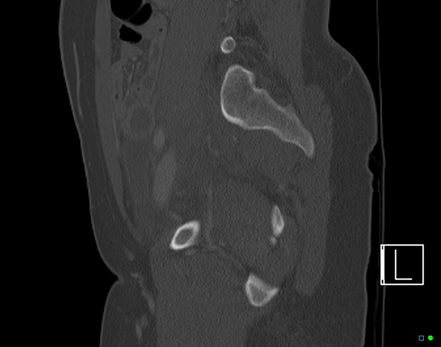 File:Bilateral acetabular fractures (Radiopaedia 79272-92308 Sagittal bone window 58).jpg
