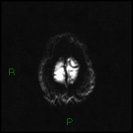 File:Bilateral acute middle cerebral artery territory infarcts (Radiopaedia 77319-89402 Axial DWI 23).jpg