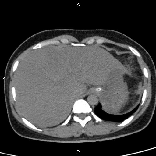 Bilateral adrenal gland hyperenhancement in pancreatitis (Radiopaedia 86642-102753 Axial non-contrast 16).jpg