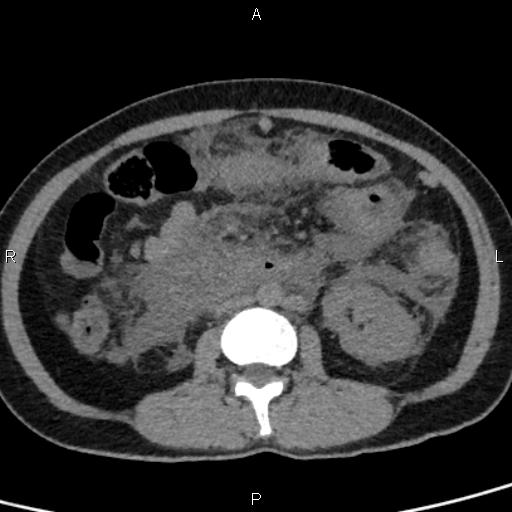 Bilateral adrenal gland hyperenhancement in pancreatitis (Radiopaedia 86642-102753 Axial non-contrast 57).jpg
