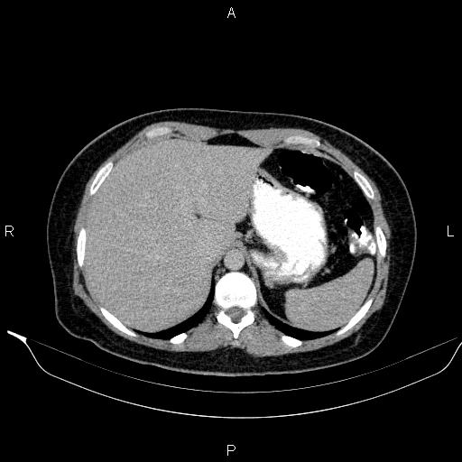 Bilateral adrenal myelolipoma (Radiopaedia 63058-71535 Axial C+ delayed 9).jpg
