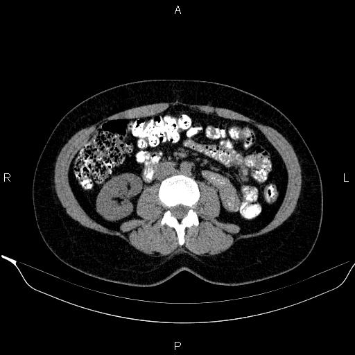 Bilateral adrenal myelolipoma (Radiopaedia 63058-71535 Axial non-contrast 90).jpg