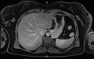 File:Bilateral adrenal myelolipoma (Radiopaedia 63058-71537 H 22).jpg