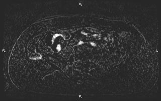 Bilateral adrenal myelolipoma (Radiopaedia 63058-71537 I 79).jpg