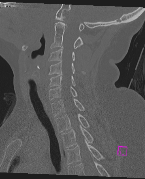 Bilateral atlanto-occipital assimilation (Radiopaedia 28350-28603 Sagittal bone window 45).jpg