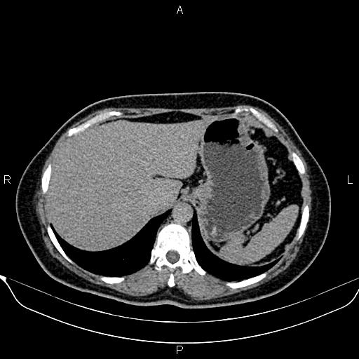 Bilateral benign adrenal adenomas (Radiopaedia 86912-103124 Axial C+ delayed 13).jpg