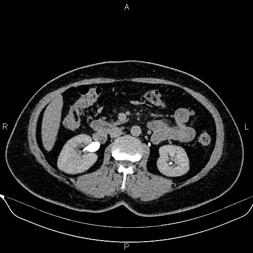 File:Bilateral benign adrenal adenomas (Radiopaedia 86912-103124 Axial C+ delayed 66).jpg