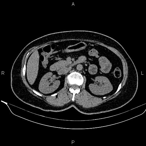 Bilateral benign adrenal adenomas (Radiopaedia 86912-103124 Axial non-contrast 48).jpg