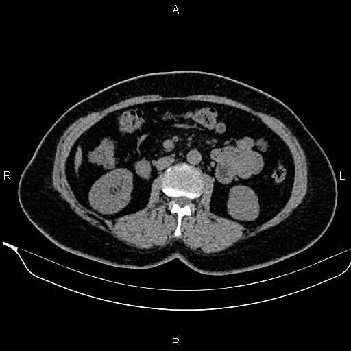 File:Bilateral benign adrenal adenomas (Radiopaedia 86912-103124 Axial non-contrast 55).jpg