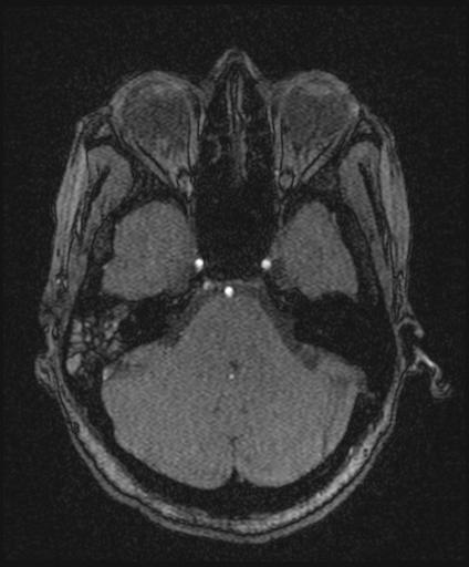 Bilateral carotid body tumors and right glomus jugulare tumor (Radiopaedia 20024-20060 Axial MRA 47).jpg