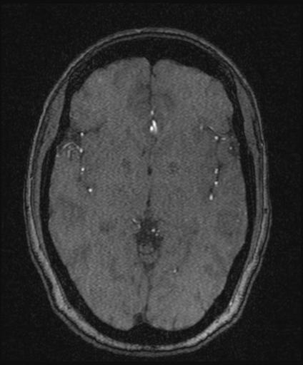 Bilateral carotid body tumors and right glomus jugulare tumor (Radiopaedia 20024-20060 Axial MRA 91).jpg