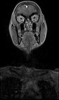 Bilateral carotid body tumors and right glomus jugulare tumor (Radiopaedia 20024-20060 MRA 2).jpg