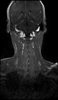 File:Bilateral carotid body tumors and right glomus jugulare tumor (Radiopaedia 20024-20060 MRA 56).jpg