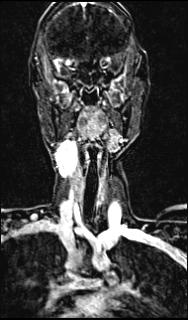 Bilateral carotid body tumors and right glomus jugulare tumor (Radiopaedia 20024-20060 MRA 86).jpg