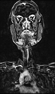 File:Bilateral carotid body tumors and right jugular paraganglioma (Radiopaedia 20024-20060 None 103).jpg