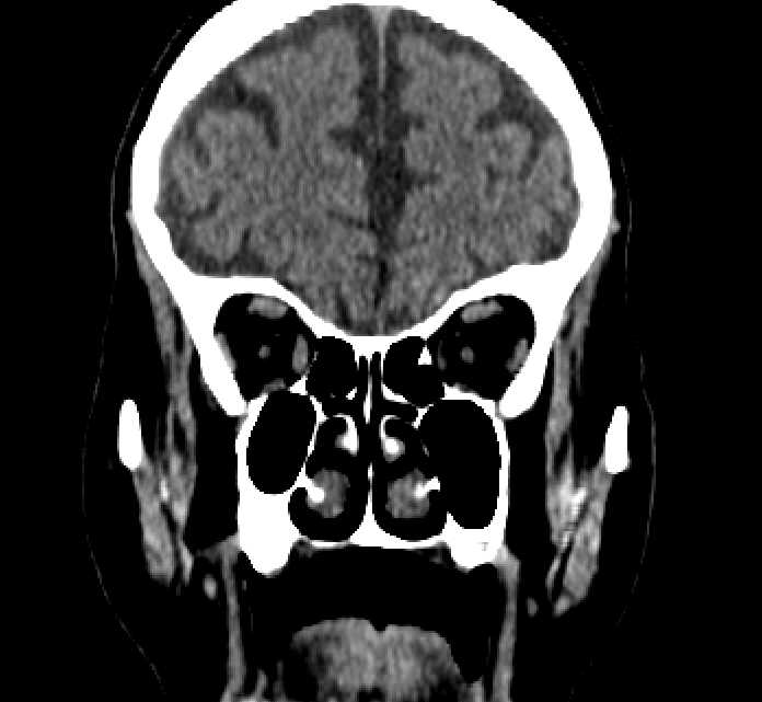Bilateral ectopia lentis (Radiopaedia 89889-107013 Coronal non-contrast 74).jpg
