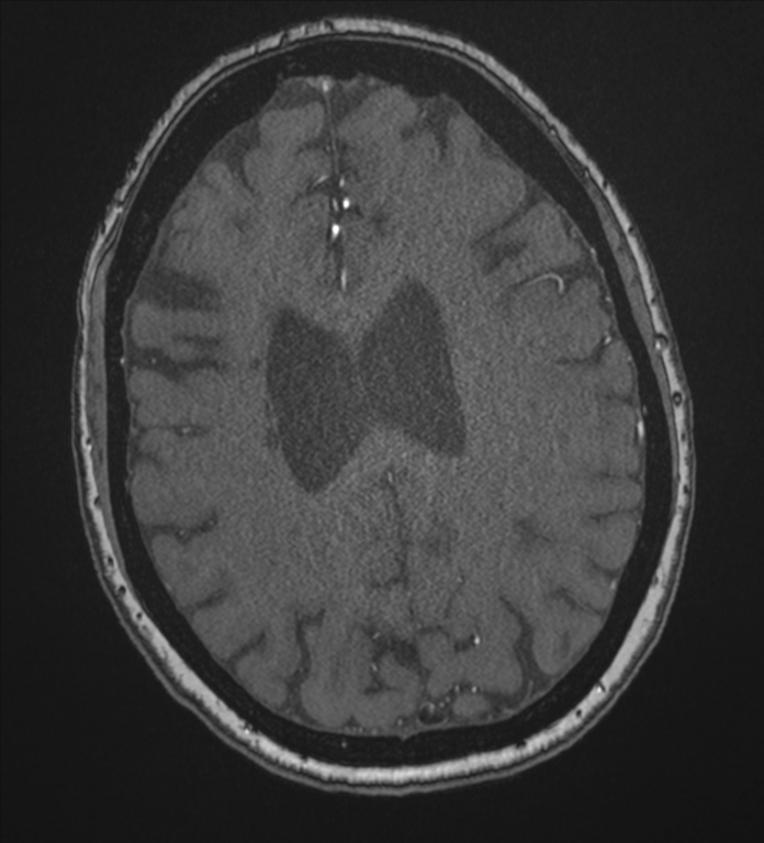 Bilateral fetal posterior communicating arteries (Radiopaedia 41286-44102 Axial MRA 156).png