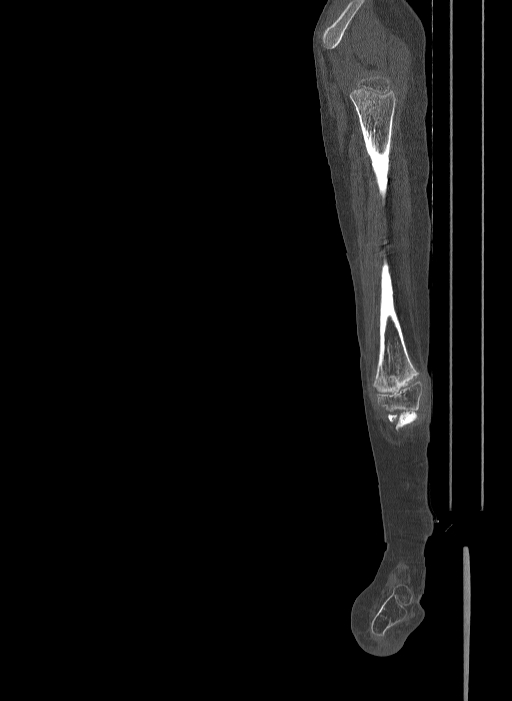 Bilateral fibular hemimelia type II (Radiopaedia 69581-79491 Sagittal bone window 24).jpg