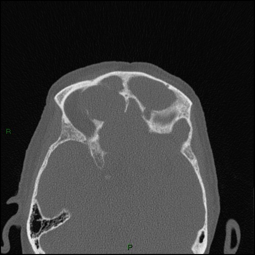 Bilateral frontal mucoceles (Radiopaedia 82352-96454 Axial bone window 114).jpg