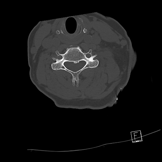 Bilateral occipital condyle fractures (type 3) (Radiopaedia 87672-104086 Axial bone window 48).jpg