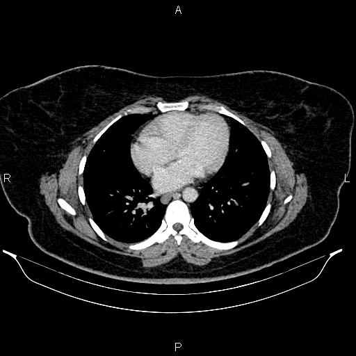 Bilateral ovarian dermoid cysts (Radiopaedia 85785-101603 A 5).jpg
