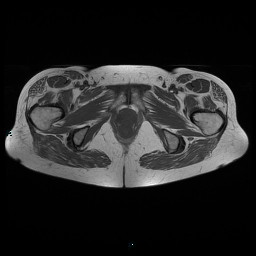 File:Bilateral ovarian fibroma (Radiopaedia 44568-48293 Axial T1 27).jpg