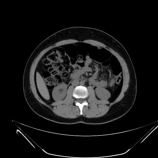 Bilateral ovarian mature cystic teratomas (Radiopaedia 79373-92457 Axial non-contrast 30).jpg