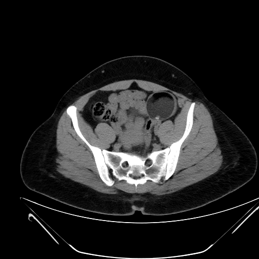 Bilateral ovarian mature cystic teratomas (Radiopaedia 79373-92457 Axial non-contrast 54).jpg