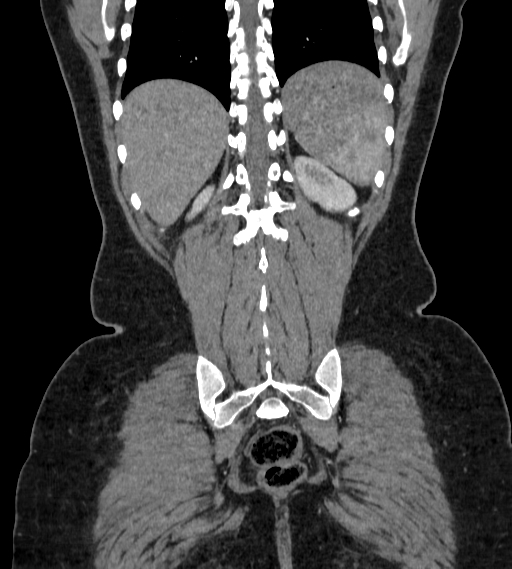 File:Bilateral ovarian mature cystic teratomas (Radiopaedia 79373-92457 B 86).jpg