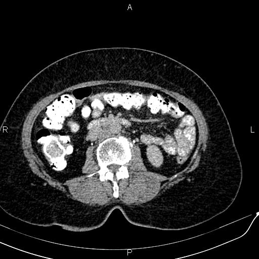 Bilateral ovarian serous cystadenocarcinoma (Radiopaedia 86062-101989 Axial C+ delayed 31).jpg