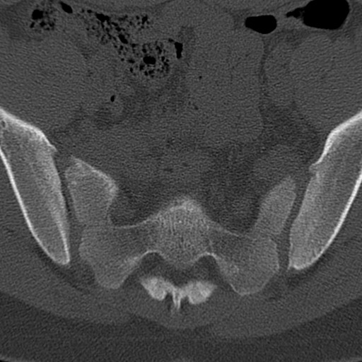 Bilateral pars defect (Radiopaedia 26691-26846 Axial bone window 101).jpg
