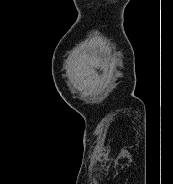 Bilateral rectus sheath hematomas (Radiopaedia 50778-56252 B 4).jpg