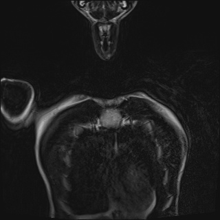 Bilateral spinoglenoid notch ganglion cysts (Radiopaedia 29577-30082 Coronal T2 11).jpg