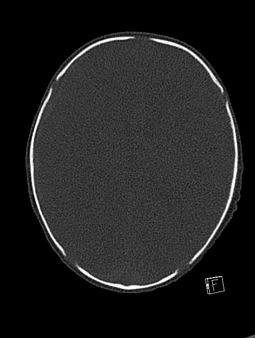 Bilateral subdural hemorrhage and parietal skull fracture (Radiopaedia 26058-26192 Axial bone window 53).png