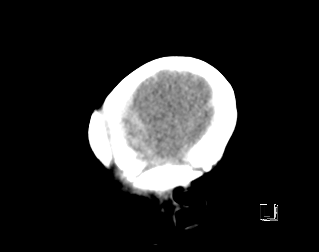 File:Bilateral subdural hemorrhage and parietal skull fracture (Radiopaedia 26058-26192 C 2).png