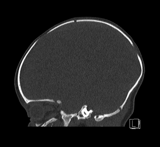 Bilateral subdural hemorrhage and parietal skull fracture (Radiopaedia 26058-26192 Sagittal bone window 63).png