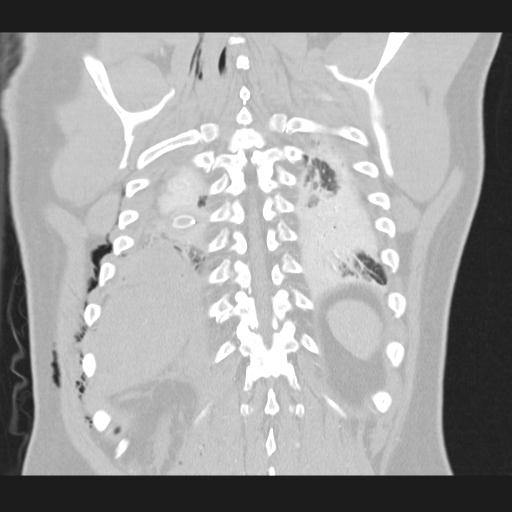 Bilateral traumatic renovascular injury (Radiopaedia 32051-32995 Coronal lung window 66).jpg