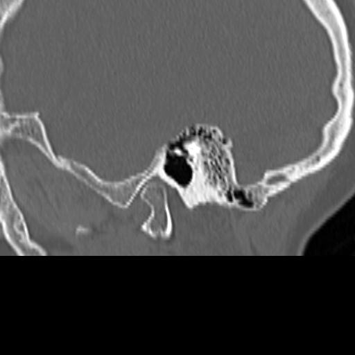 File:Bilateral tympanoplasty (Radiopaedia 16947-16664 Sagittal bone window 16).jpg