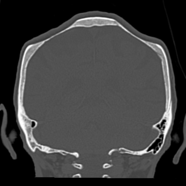 Biparietal osteodystrophy (Radiopaedia 46109-50463 Coronal bone window 74).jpg