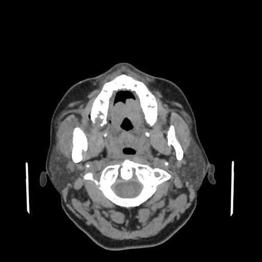 File:Bisphosphonate-related osteonecrosis of the jaw (Radiopaedia 71324-81642 non-contrast 105).jpg