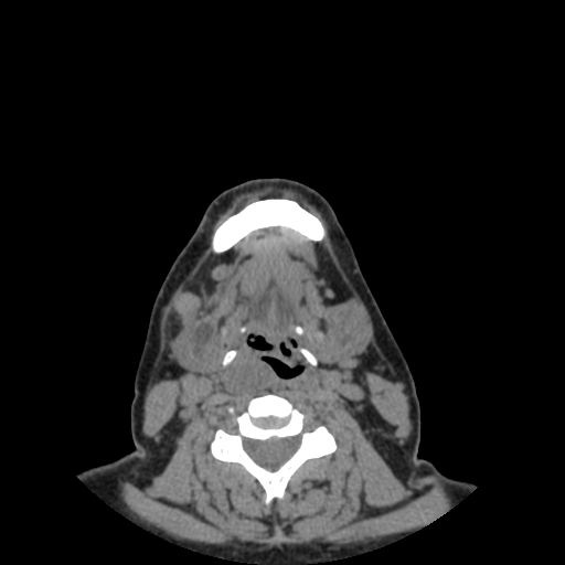 Bisphosphonate-related osteonecrosis of the jaw (Radiopaedia 71324-81642 non-contrast 16).jpg