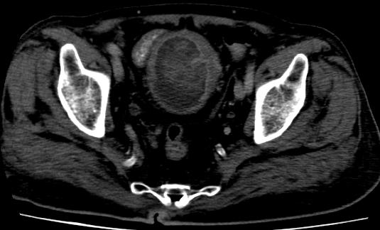 File:Bladder carcinoma (Radiopaedia 15813-15458 B 1).JPG