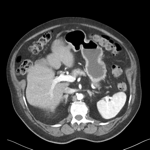 File:Bladder papillary urothelial carcinoma (Radiopaedia 48119-52951 A 13).png