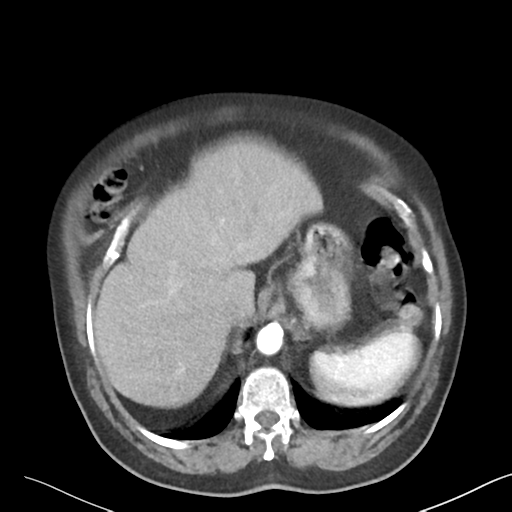 File:Bladder papillary urothelial carcinoma (Radiopaedia 48119-52951 A 6).png