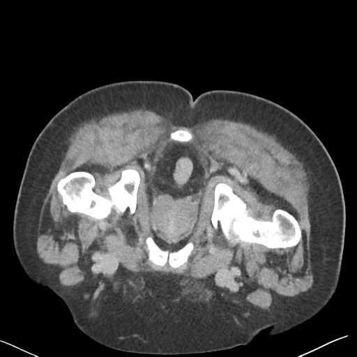 File:Bladder papillary urothelial carcinoma (Radiopaedia 48119-52951 Axial C+ delayed 60).png
