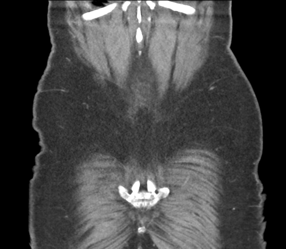 File:Bladder papillary urothelial carcinoma (Radiopaedia 48119-52951 C 59).png