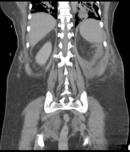 Bladder rupture post renal biopsy (Radiopaedia 30863-31572 Coronal non-contrast 46).jpg