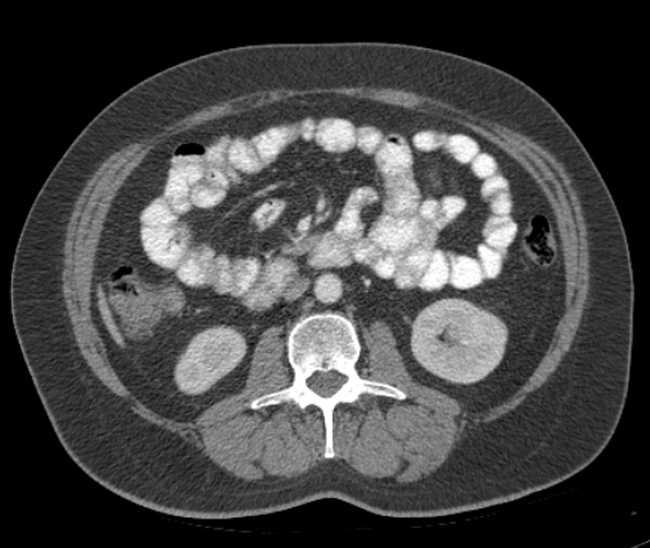 File:Bleeding duodenal ulcer and adenomyomatosis of gallbladder (Radiopaedia 61834-69861 A 60).jpg